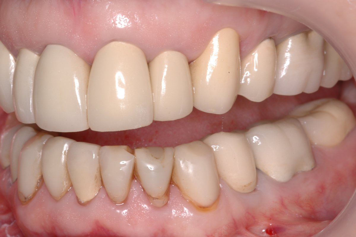 case-3-comprehensive-rehabilitation-with-zirconia-crowns-in-house